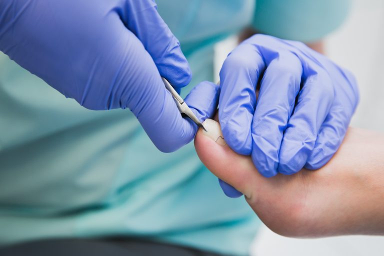 Virtually Pain Free Ingrown Toenail Removal