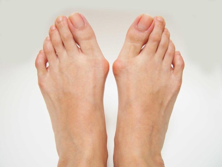 Bunions Treated in South Texas